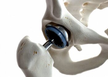 O que é Artroplastia do quadril?