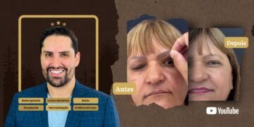 Blefaroplastia em São Bernardo do Campo: Vera Realiza o Sonho de um Olhar Jovem com Dr. Rodrigo Bra