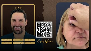 Blefaroplastia em São Bernardo do Campo: Vera Realiza o Sonho de um Olhar Jovem com Dr. Rodrigo Bra