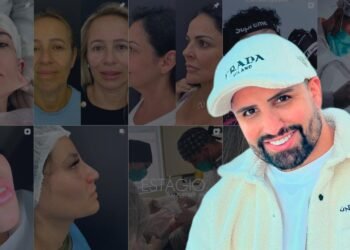 Minilifting se torna a cirurgia mais desejada pelas mulheres, afirma Dr. Rodrigo Soares.