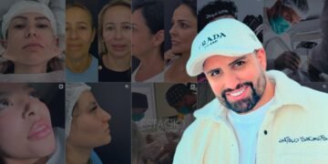 Minilifting se torna a cirurgia mais desejada pelas mulheres, afirma Dr. Rodrigo Soares.