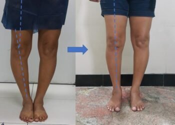 Alinhamento das pernas antes e depois da correção do joelho varo