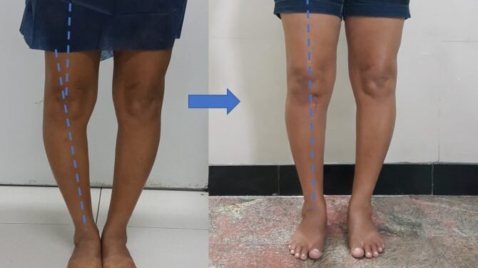 Alinhamento das pernas antes e depois da correção do joelho varo