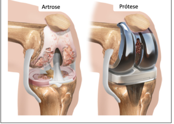 Substituição articular com a prótese do joelho
