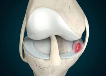 Ilustração 3D da ruptura do menisco
