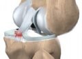 Ilustração da ruptura do ligamento cruzado posterior