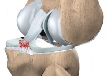 Ilustração da ruptura do ligamento cruzado posterior