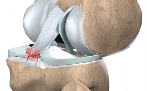 Ilustração da ruptura do ligamento cruzado posterior
