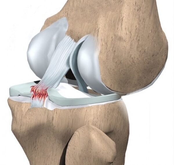 Ilustração da ruptura do ligamento cruzado posterior