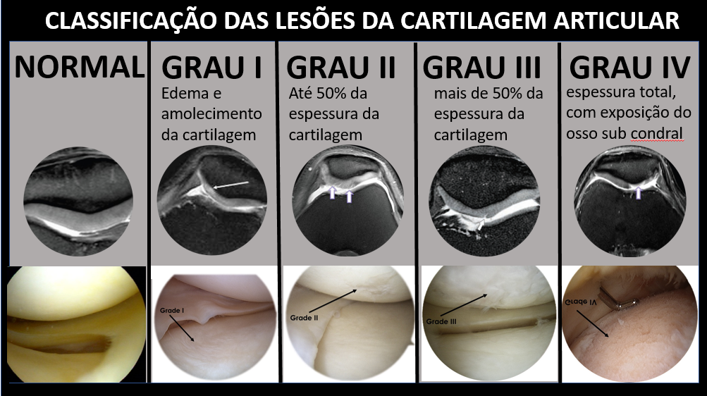 Classificação das lesões da cartilagem do grau I ao IV