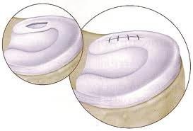 Reparo meniscal antes e depois da sutura