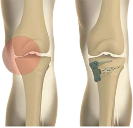 Osteotomia da tíbia antes e depois com placa de fixação