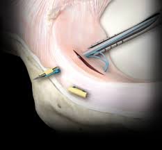 Sutura meniscal artroscópica