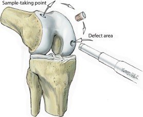 Transplante osteocondral com retirada do enxerto