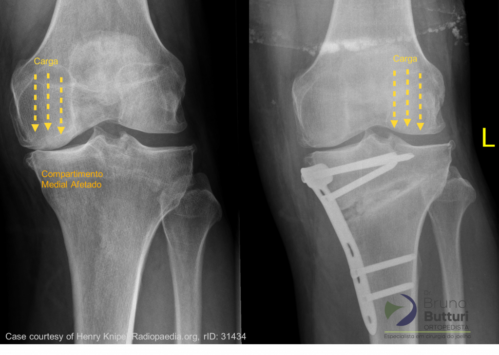 Radiografia da osteotomia da tíbia antes e depois