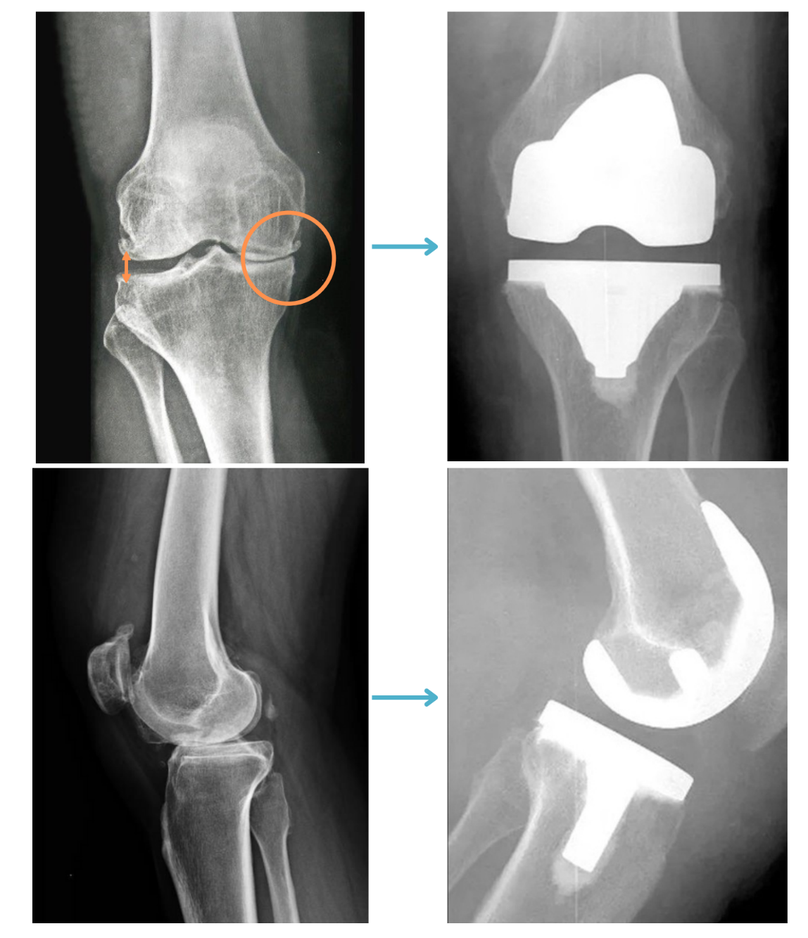 Radiografia do joelho antes e depois da prótese total