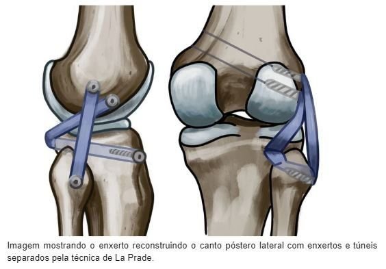 Reconstrução do canto posterolateral