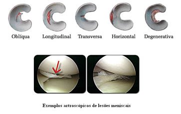 Tipos de lesões meniscais