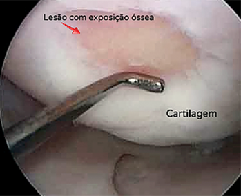 Lesão da cartilagem com exposição óssea vista por artroscopia
