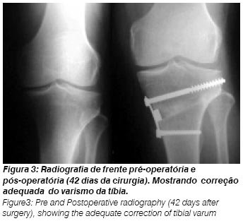 Radiografia pré e pós-operatória com correção do varo