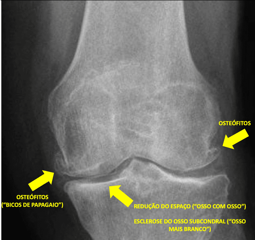 Radiografia de artrose do joelho