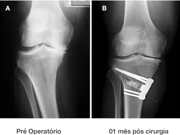 Radiografia antes e um mês após a osteotomia