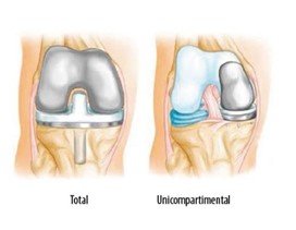 Prótese de joelho total e unicompartimental