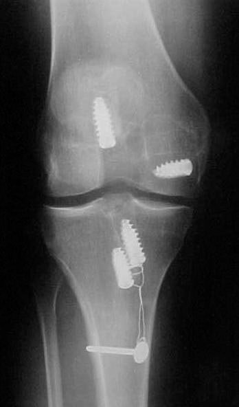 Radiografia após reconstrução multiligamentar