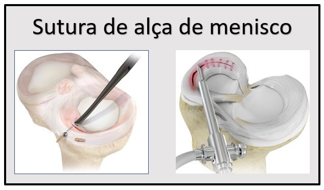 Sutura de alça de menisco