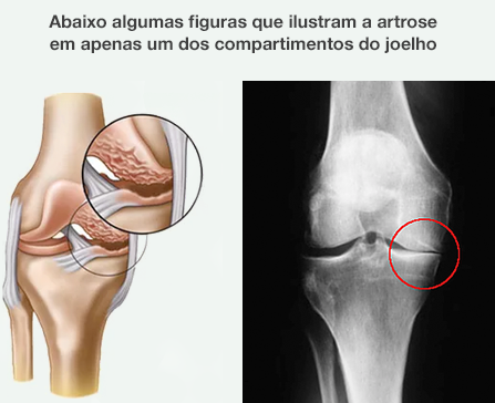 Artrose em um compartimento do joelho