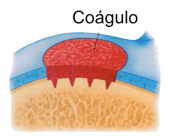 Coágulo sobre a lesão após microfraturas