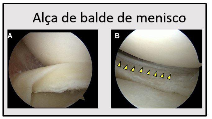 Lesão em alça de balde do menisco