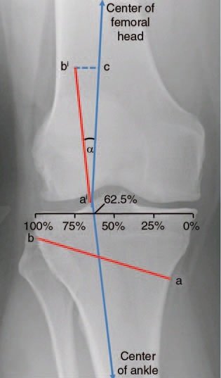 Planejamento da osteotomia com eixo mecânico