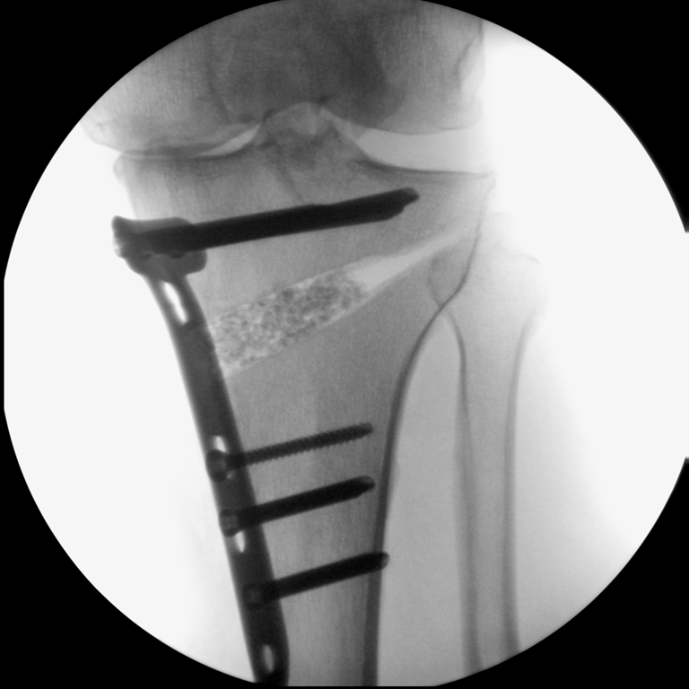 Radiografia intraoperatória da osteotomia da tíbia