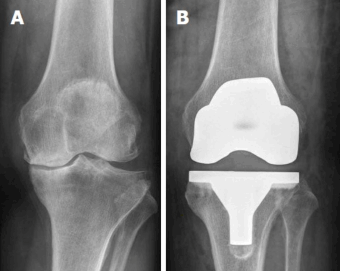 Radiografia do joelho antes e depois da prótese