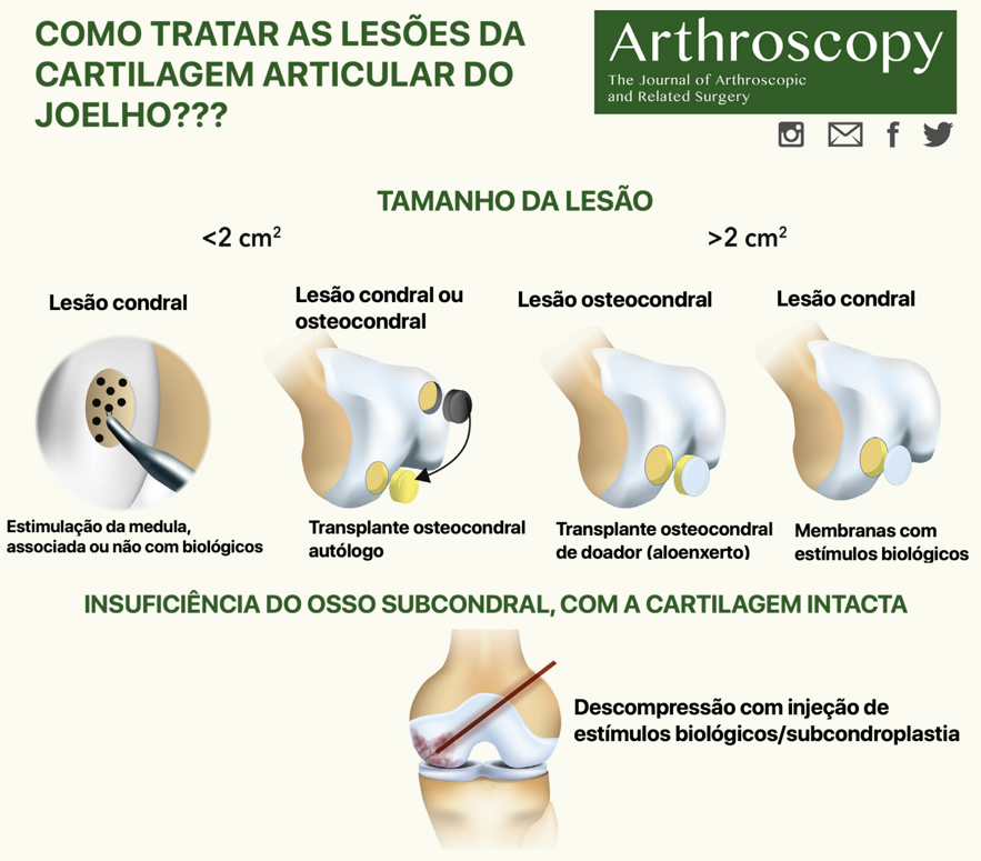 Opções de tratamento conforme o tamanho da lesão da cartilagem
