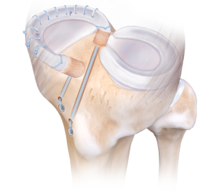 Ilustração de técnica de reparo meniscal