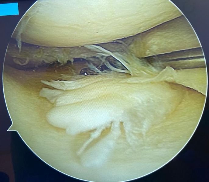 Lesão meniscal complexa por artroscopia
