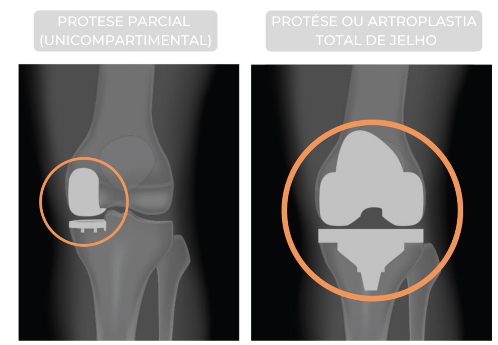 Prótese parcial e prótese total na radiografia