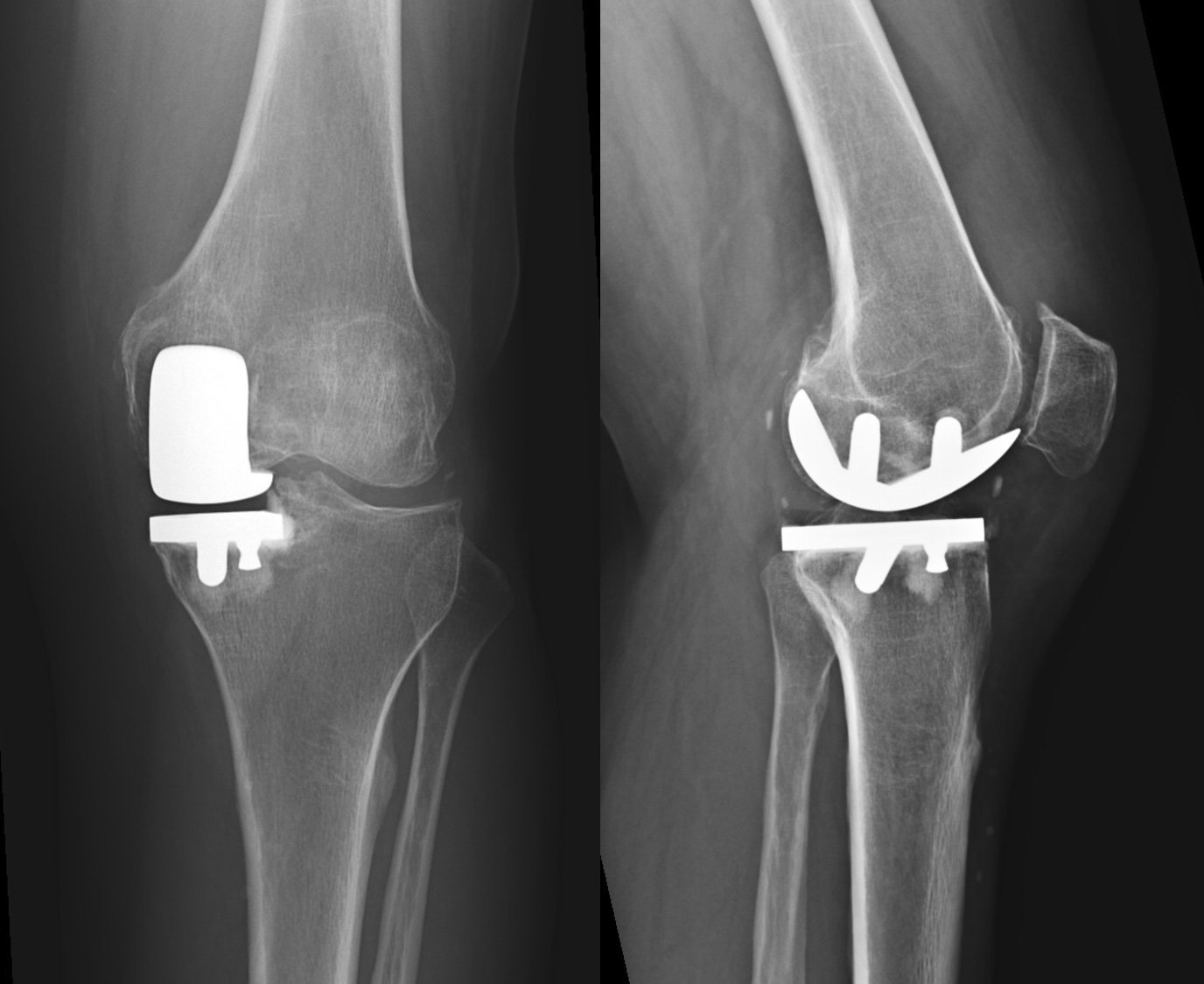 Radiografia de prótese unicompartimental do joelho