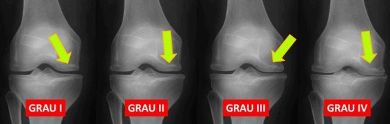 Classificação da artrose do grau 1 ao grau 4