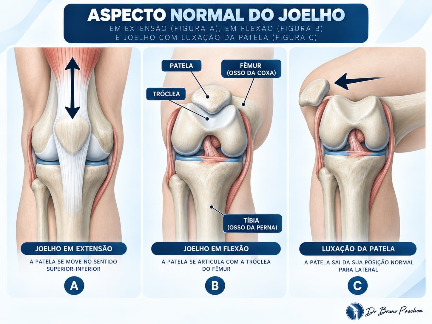 Joelho normal em flexão e extensão comparado à luxação da patela