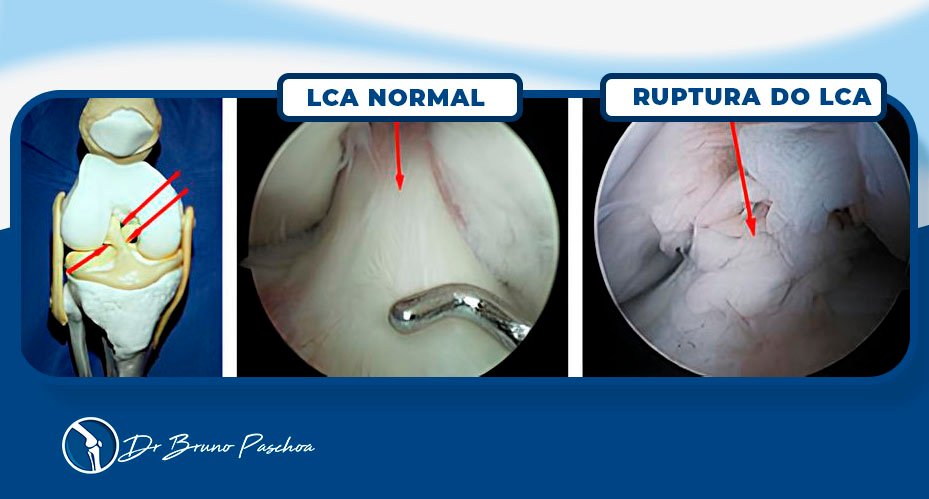 Comparação artroscópica entre LCA normal e rompido