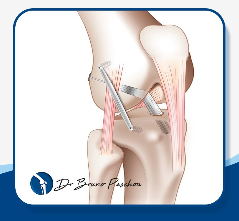 Reconstrução do LCA com reforço anterolateral