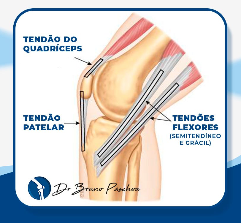 Tipos de enxerto para reconstrução do LCA