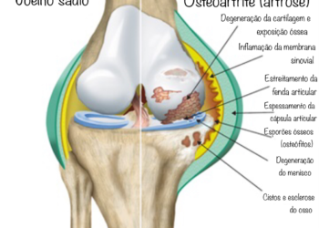 Joelho sadio e joelho com artrose, com degeneração da cartilagem e inflamação