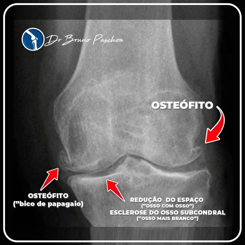 Radiografia do joelho com esclerose do osso subcondral