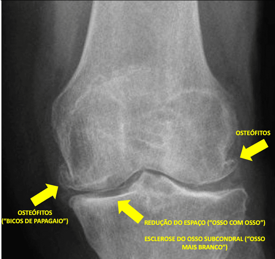 Radiografia do joelho com esclerose do osso subcondral