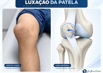 Joelho com luxação da patela