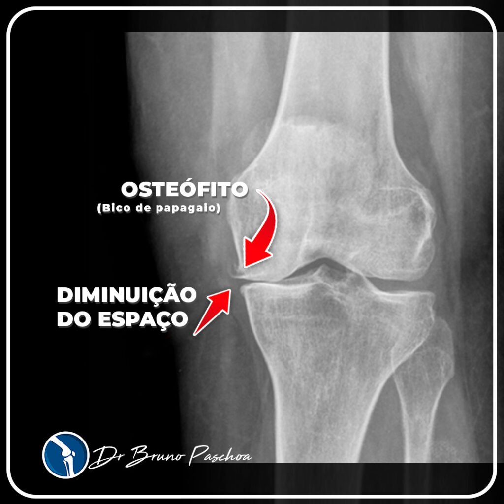 Osteófito conhecido como bico de papagaio